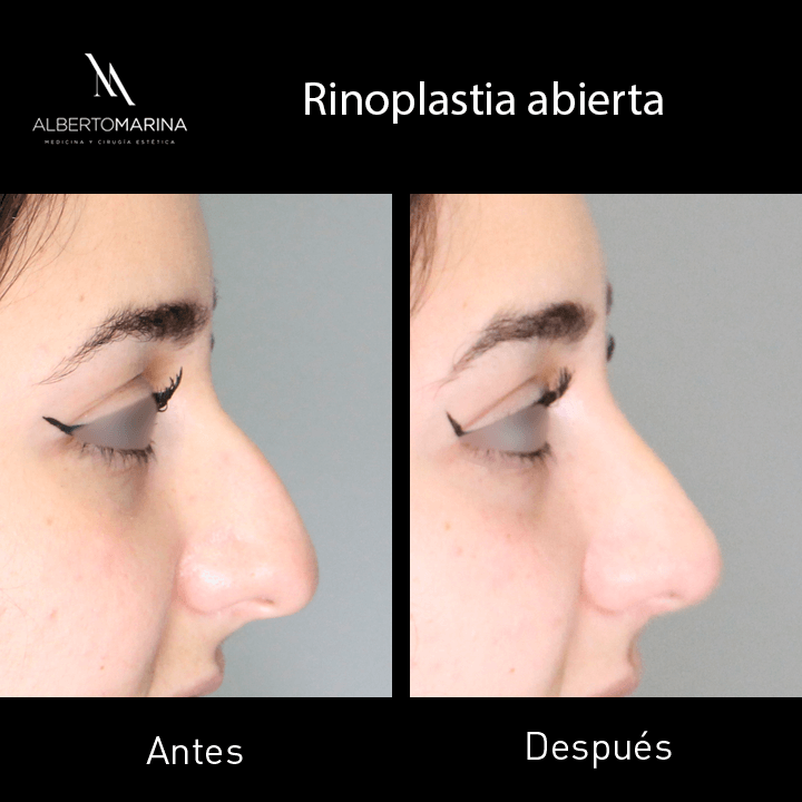 RINOPLASTIA-ABIERTA-LHG-3M_01