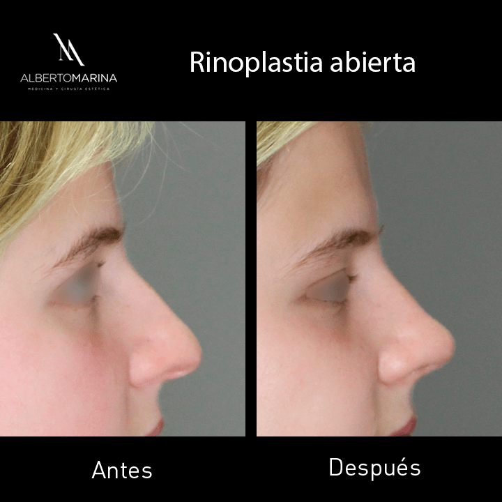 RINOPLASTIA-ABIERTA-MFDJ-3M_01