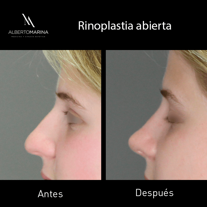RINOPLASTIA-ABIERTA-MFDJ-3M_02
