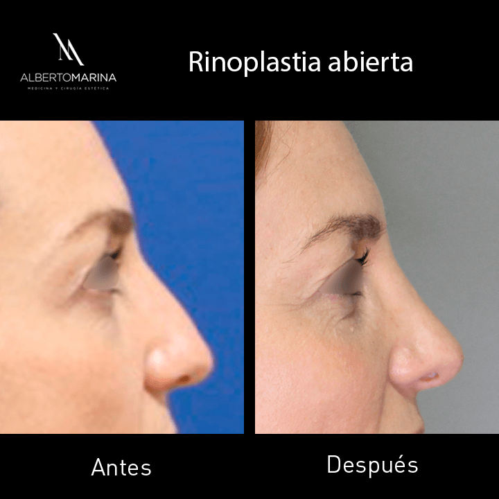 RINOPLASTIA-ABIERTA-MLC-12M_01