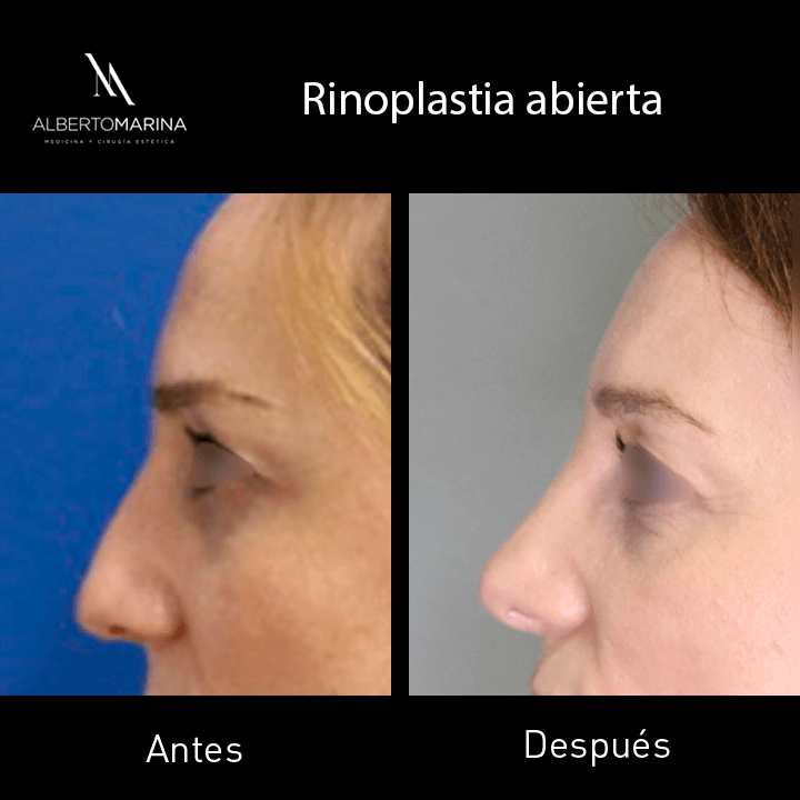 RINOPLASTIA-ABIERTA-MLC-12M_02