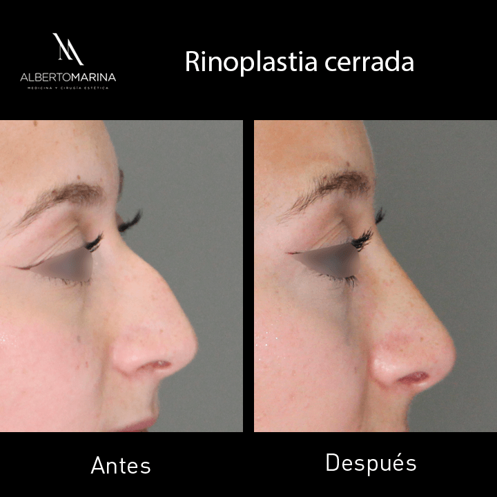 RINOPLASTIA-CERRADA-AAN_01