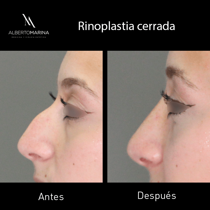 RINOPLASTIA-CERRADA-AAN_02