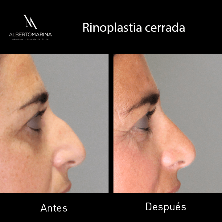 RINOPLASTIA-MVH-_6M_01