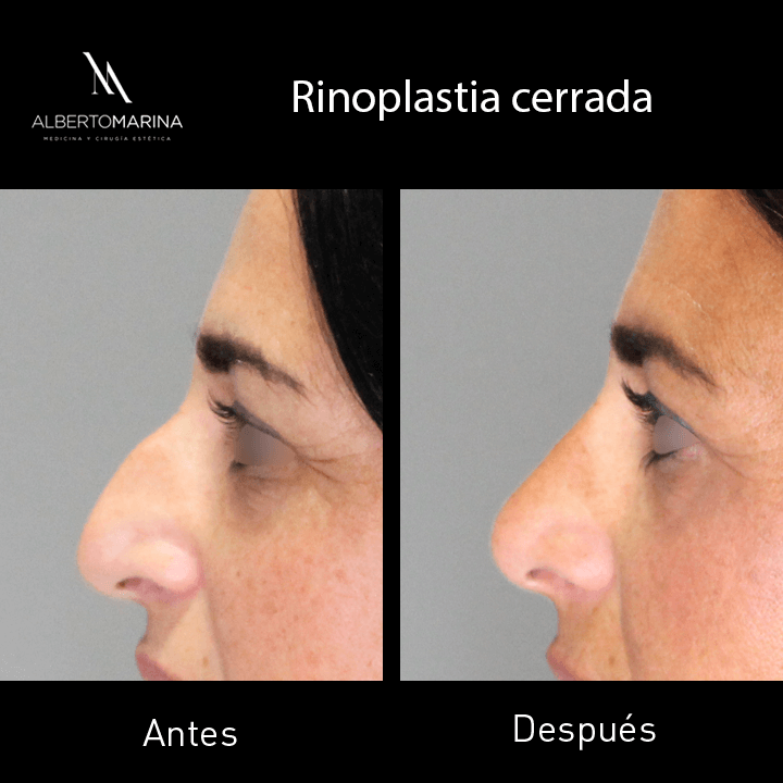 RINOPLASTIA-MVH-_6M_02